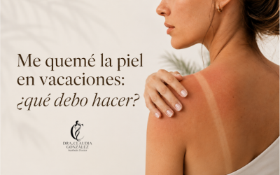 Me quemé la piel en vacaciones: ¿qué debo hacer?